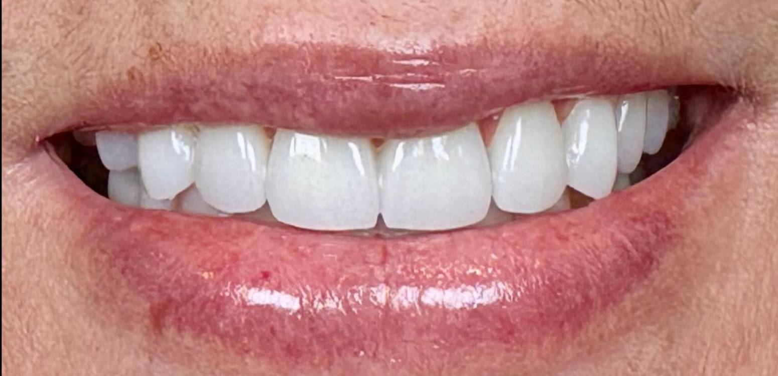 After dental treatment